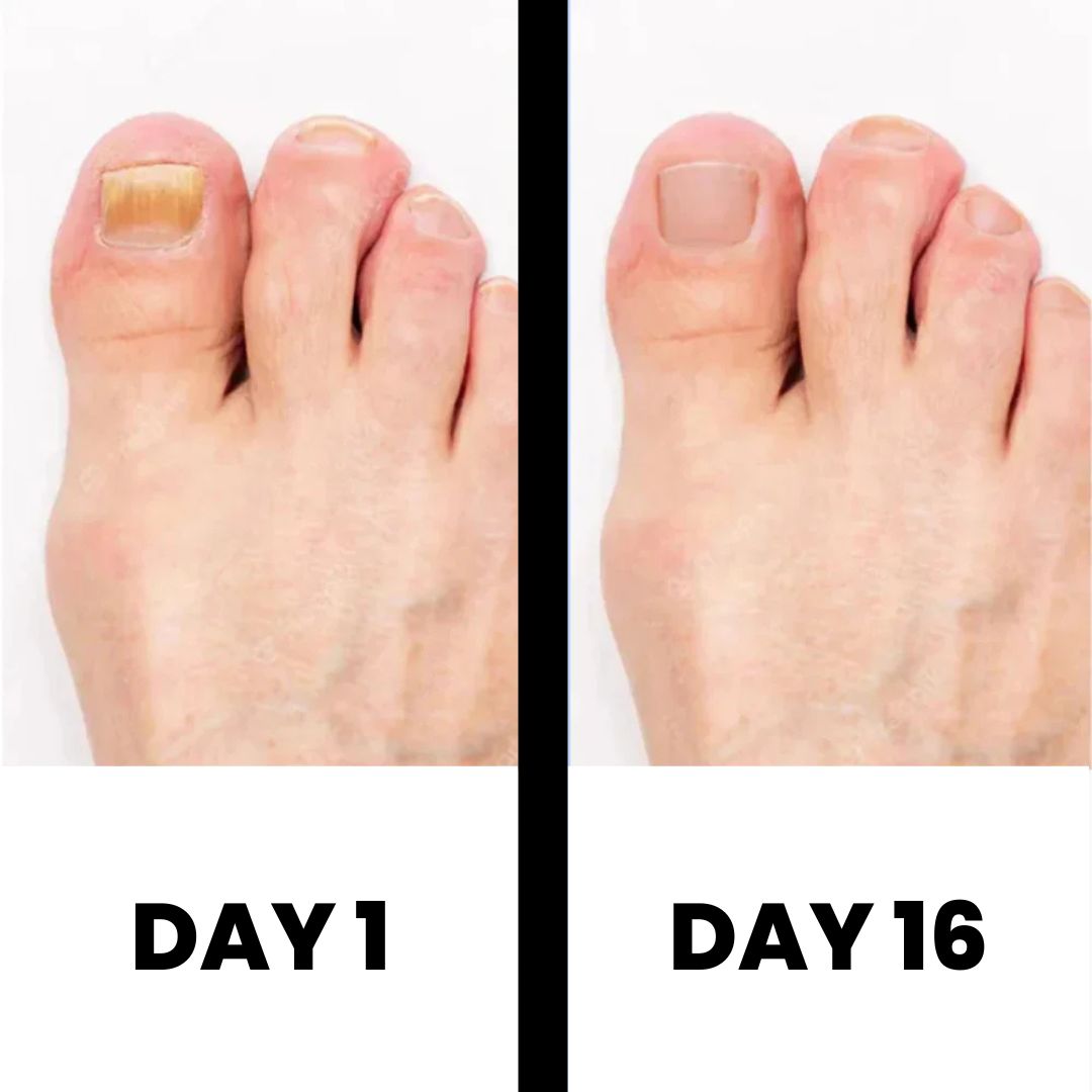 DermaNail – Patented nail fungus therapy – for healthy nails within 4 weeks Success